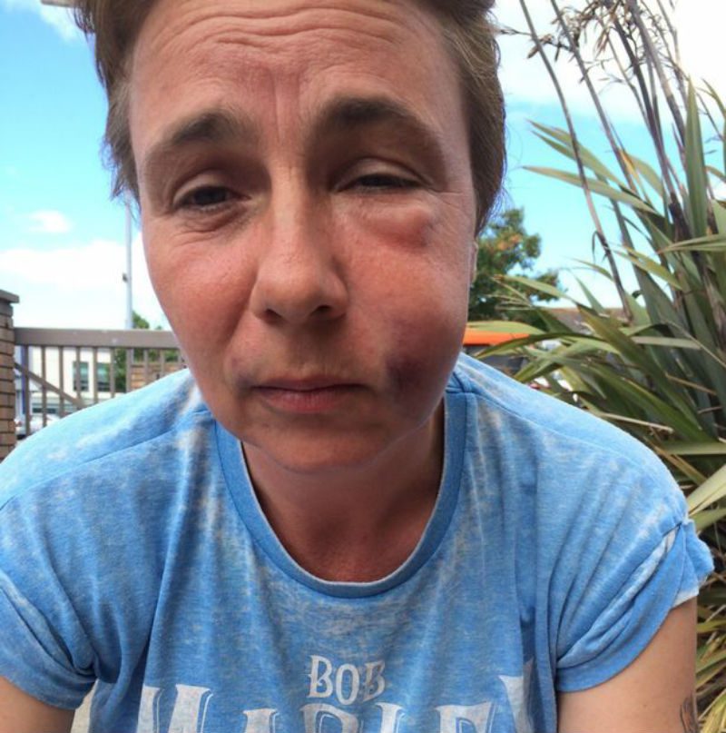 Jackie-Hatton-physically-assaulted-in-homophobic-attack Jackie-Hatton-physically-assaulted-in-homophobic-attack